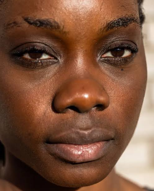Hyperpigmentation Kenya: Essential 2026 Guide to Dark Spots and Safe Skin Care
