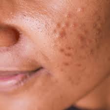 Adult Acne Kenya: Building a Safe Routine That Does Not Backfire