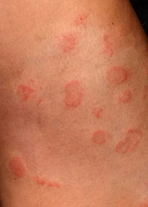 Skin Rash Kenya: What a Pharmacist Can Assess and What Needs a Clinic